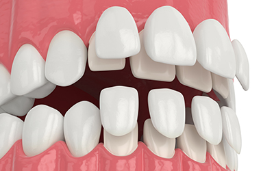 upper and lower veneers